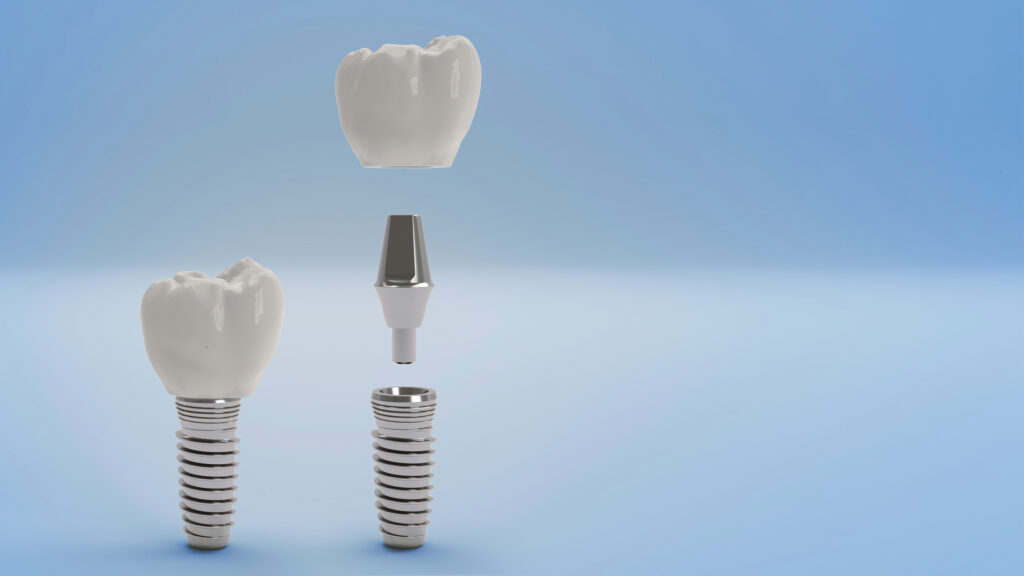 Dental Implants in Towson, MD