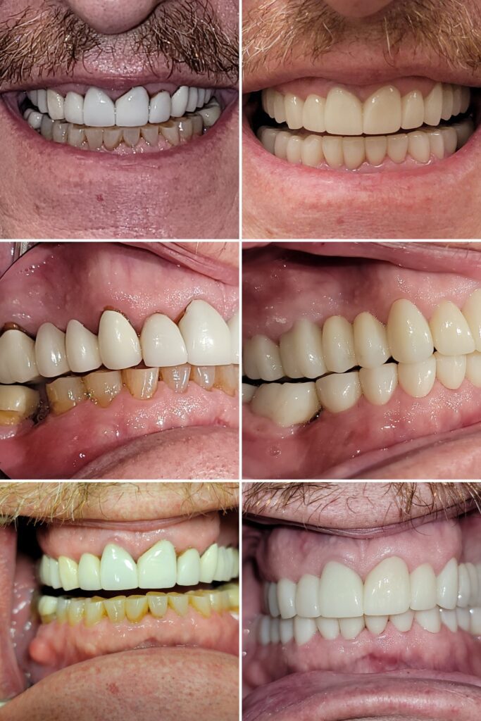Full Mouth Reconstruction in Towson, MD