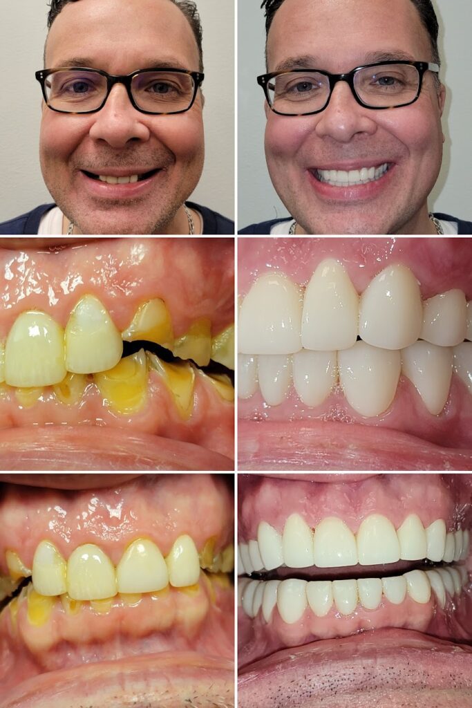 Before and after the smile design process at Love Your New Smile