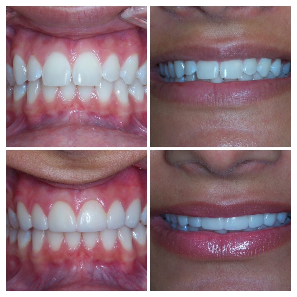 Before and after a porcelain veneers treatment