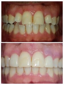 pt had  crooked lateral that were undersized and had spacing issues. The patient went through clear braces, Bleaching, and than bonding on lateral incisors to make the shape more pleasing   