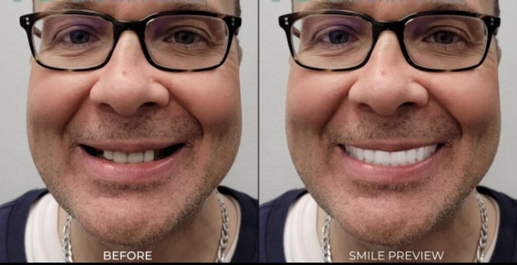Before and after smile design