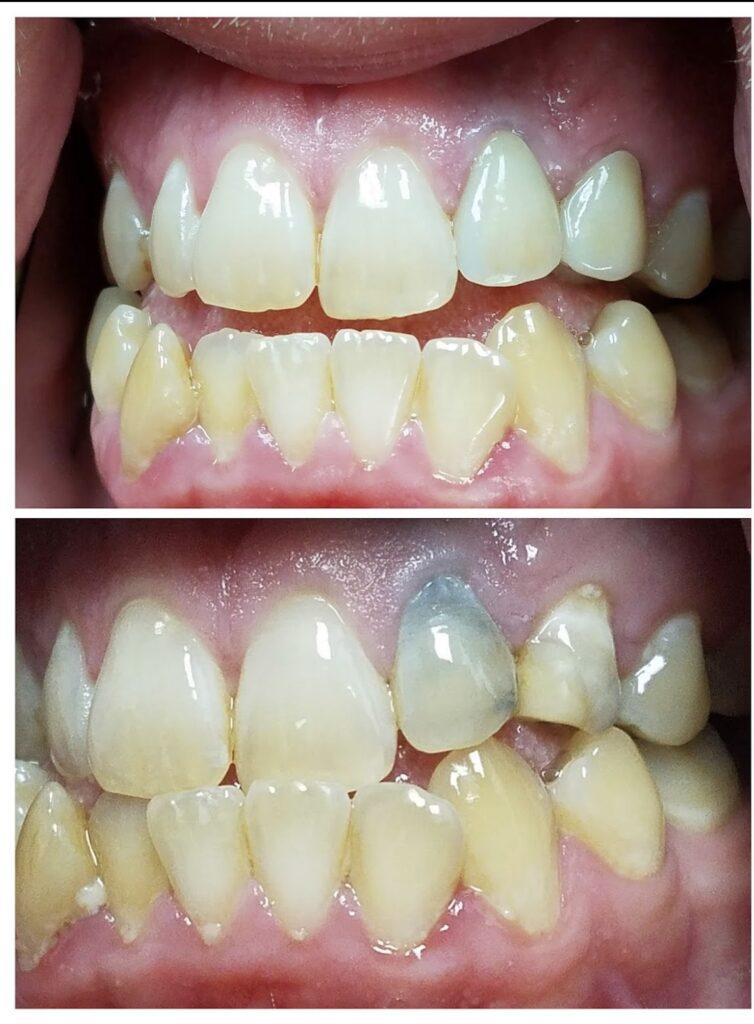 Before and after a dental crown procedure